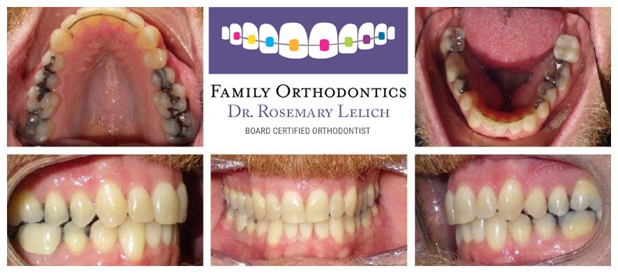 Before and After Gallery - Family Orthodontics