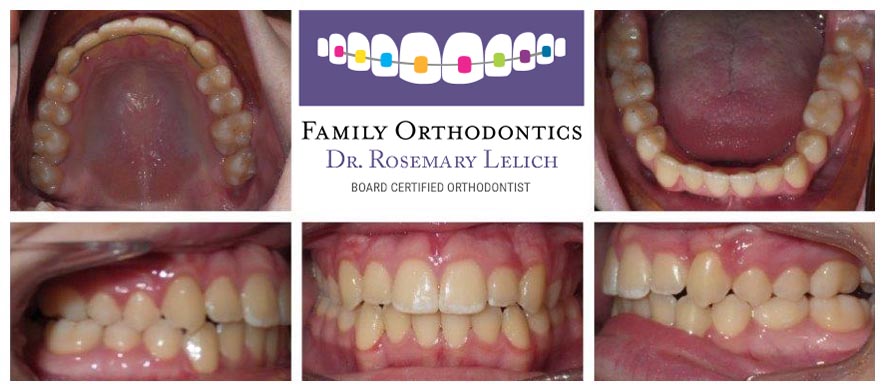 Before and After Gallery - Family Orthodontics