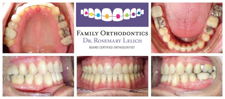 Before and After Gallery - Family Orthodontics