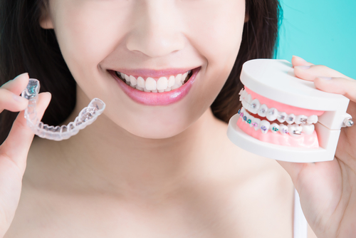 Adult Braces - Different Types of Adult Braces and what is right for you