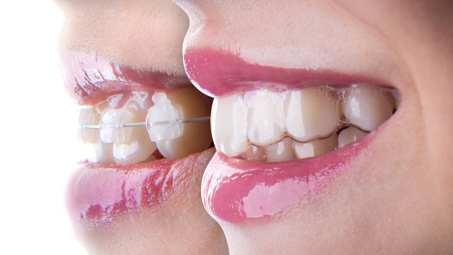 Clear Braces - Different Types of Clear Braces