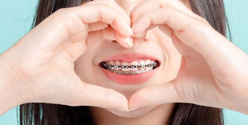 wearing braces - what it's like to have braces