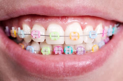 Wearing Braces - list of benefits of wearing braces