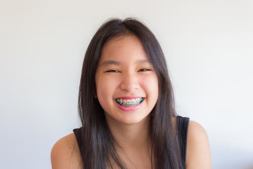 Life with Braces - What to expect when wearing braces