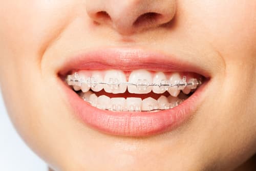 Life with Braces - What it feels like to wear braces