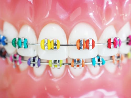 Life with Braces - how to express who you are with braces