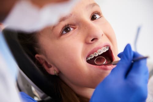 Life with Braces - How long do you have to have your braces?