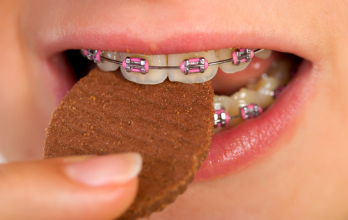 Eating with Braces - What you should and shouldn't eat while having braces