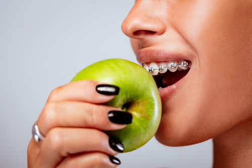 Eating with Braces - Eating Restrictions while having braces
