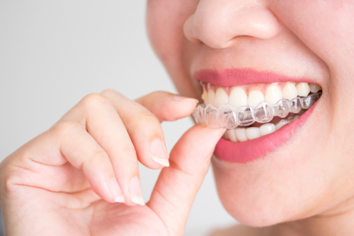 Invisalign Timetable - How Long Until You See Results?