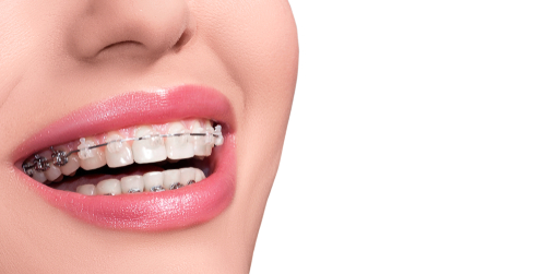 invisalign vs. metal braces -Benefits of Metal Braces