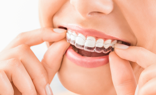 invisalign vs. metal braces - Perks of Invisalign 