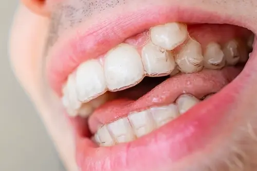 Invisalign Candidate - gapped teeth, crooked teeth are a few reasons to get invisalign