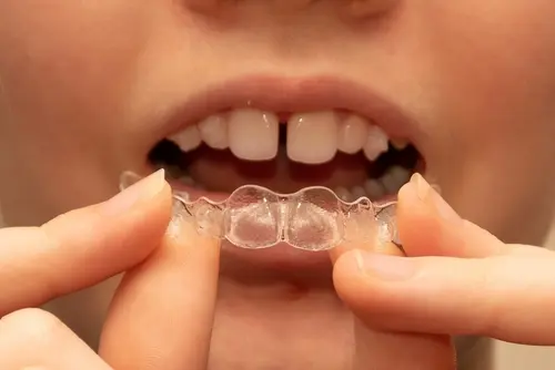 Invisalign Candidate - Invisaligns are discreet, comfortable and give you freedom