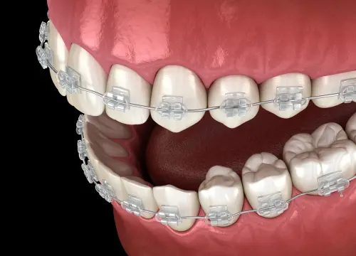 Benefits of LightForce Brackets - Family Ortho Will Show You