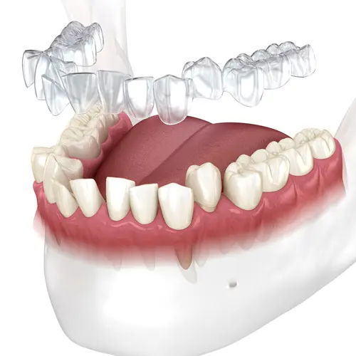 Characteristics of LightForce Braces - Family Ortho