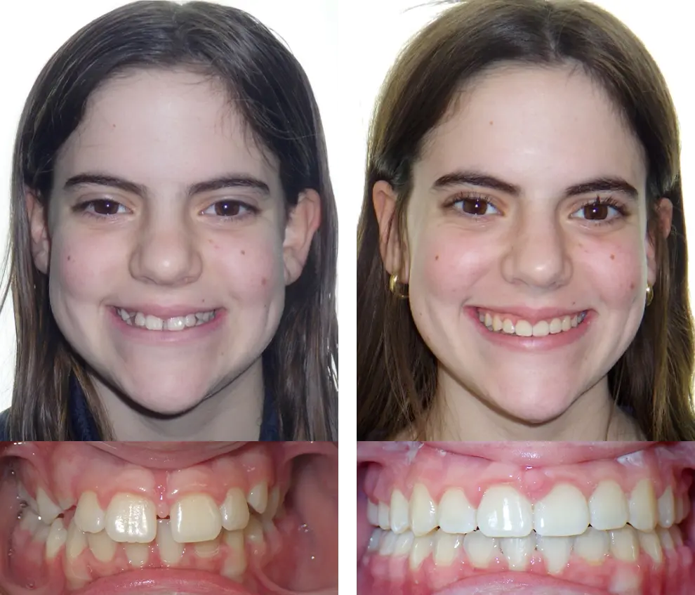 Lauren C. Before & After