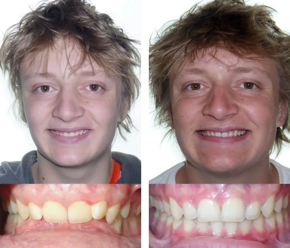 Jack B. Smile Before and After