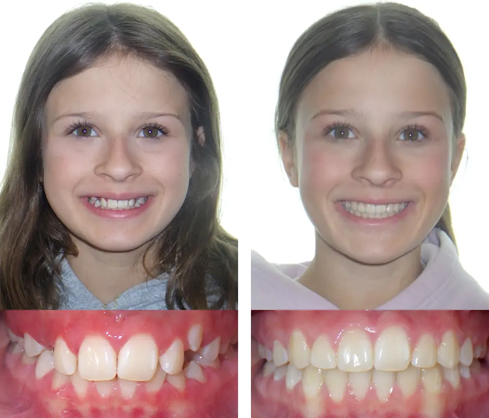 Elsa G. Before and After