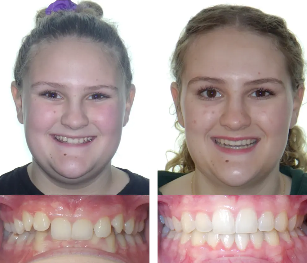 Ellie V. Before and After